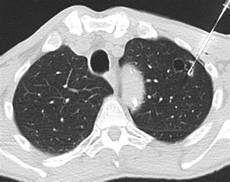 Ct Guided Core Needle Biopsy Of Pulmonary Lesions Associated With Cystic Airspaces A Case