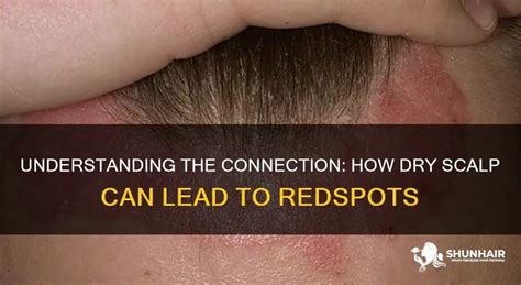 Understanding The Connection How Dry Scalp Can Lead To Redspots Shunhair