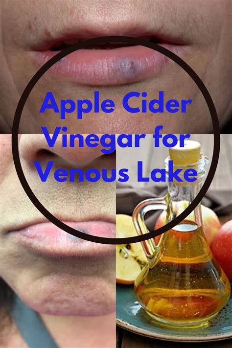 Apple Cider Vinegar For Venous Lake Venous Lake Treatment Apple Cider Vinegar Cider Cider