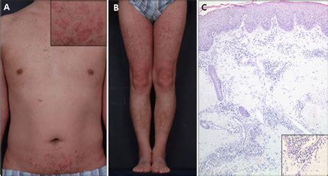 Clinical Findings Of Pityriasis Rubra Pilaris Presented At The First