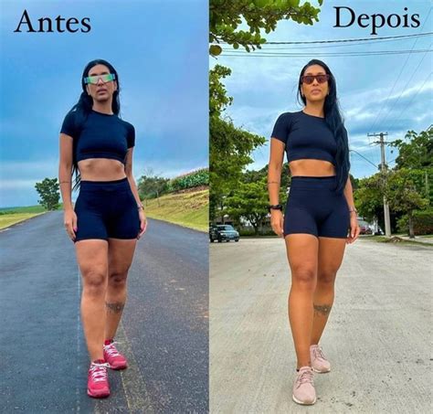 Amanda Djehdian mostra antes e depois um ano após cirurgia de lipedema