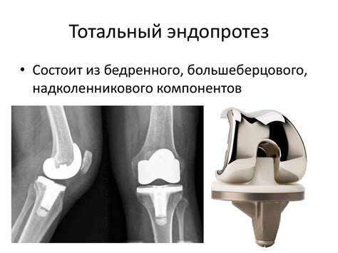 Эндопротезирование тазобедренного, коленного суставов - презентация онлайн