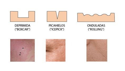 Secuelas De Acne Clínica Uniderma Perú