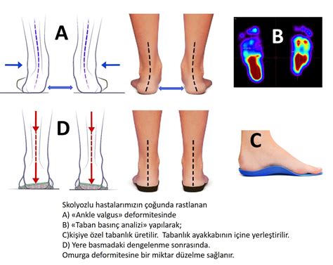 Skolyoz Tabanlığı