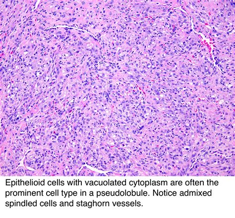 Pathology Outlines Sclerosing Stromal Tumor