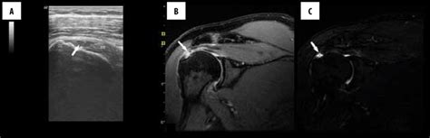 Supraspinatus MRI