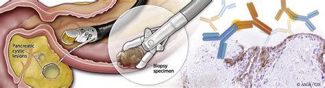 Eus Guided Through The Needle Biopsy Sampling Of Pancreatic Cystic Lesions A Pathologists