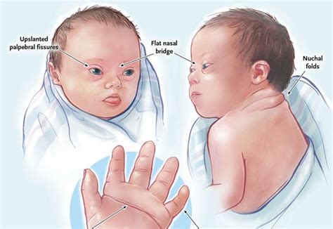 Down Syndrome Nejm Resident 360