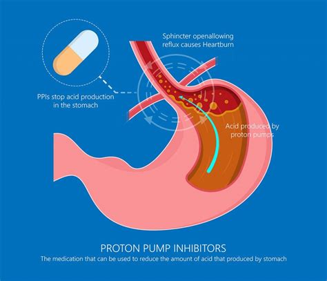 Effective Acid Reflux Treatment Options Ask The Nurse Expert