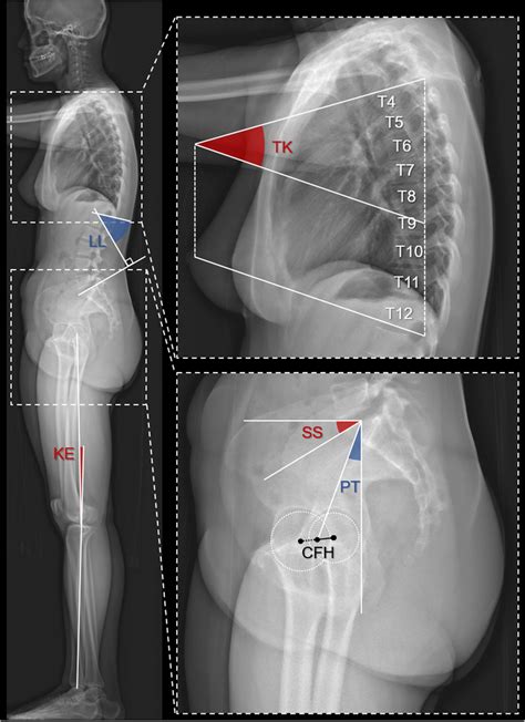 The Graph Shows How Sagittal Spinopelvic Parameters Were Measured