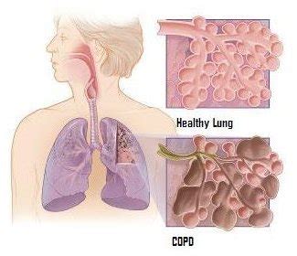 Copd The Final Stages