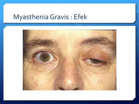 Myasthenia gravis and antibiotics use