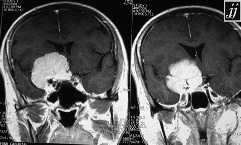 Right Supra Parasellar Meningioma Radiopaedia