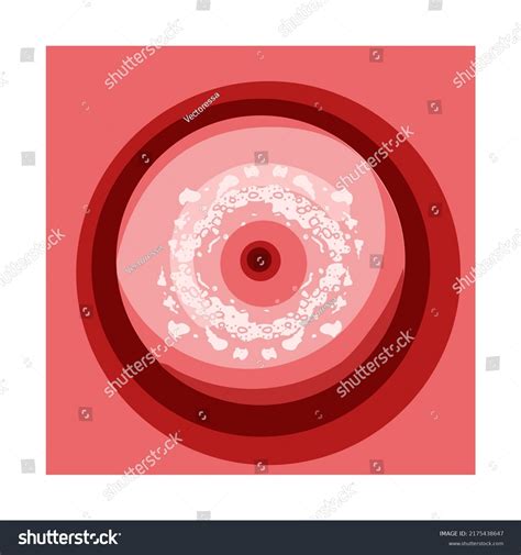 Cervical Cancer Dysplasia Cin 1 Stage Stock Vector Royalty Free