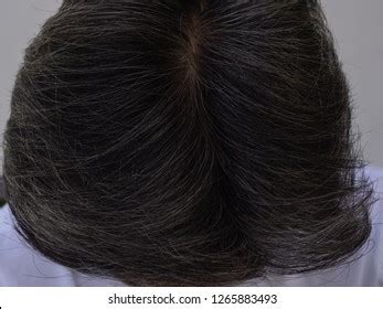 White Hair Hair Hair Loss Baldnesshair Stock Photo 1265883493 ...