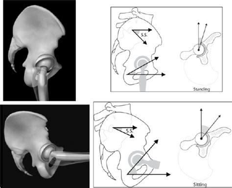 In Standing Positions There Is Less Cross Sectional Anteversion Than