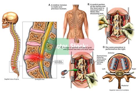 Back Surgery L4 5 Disc Herniation With Laminectomy And Spinal Fusion