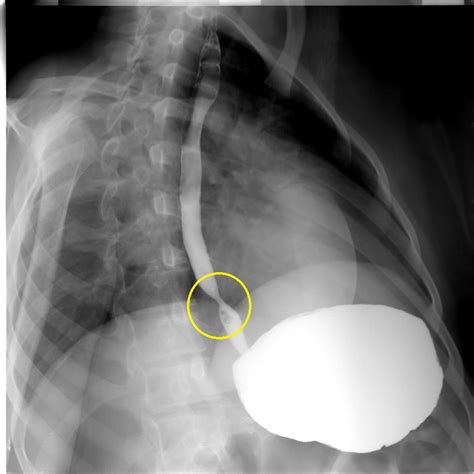 Esophageal Web Wikidoc