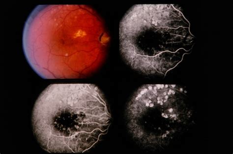 Central Serous Retinopathy - Retina Image Bank