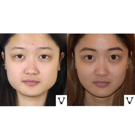 Wide Nose Rhinoplasty Asian