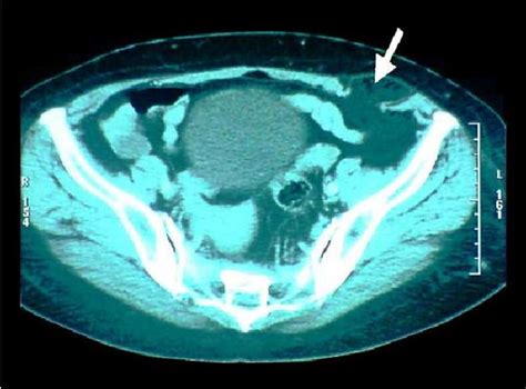 Tomodensitom Trie Abdominale Coupe Axiale Montrant Une Hernie De