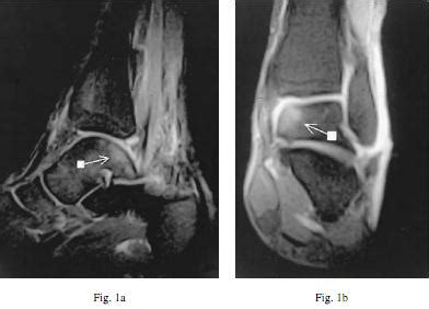 Bone bruise - Physiopedia