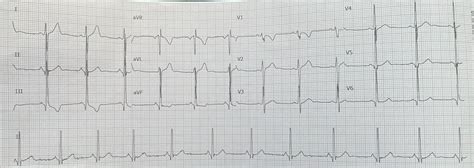 RV strain or normal physiological hypertrophy? : r/EKGs