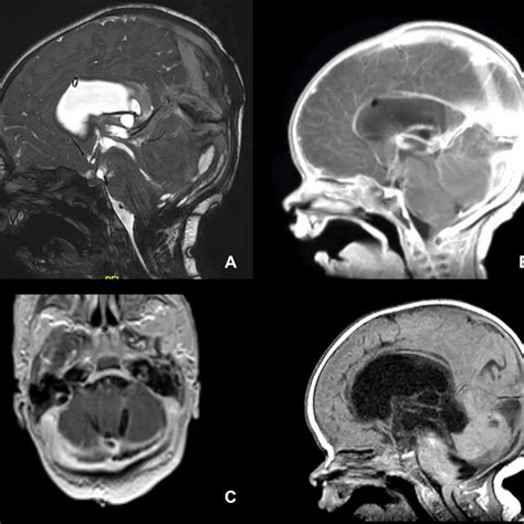 A Endoscopic Intraoperative Image Of The Posterior Fossa Cyst Where Is