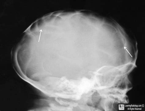 Lacunar Skull. There are multiple focal areas of radiolucency in the skull (white arrows ...