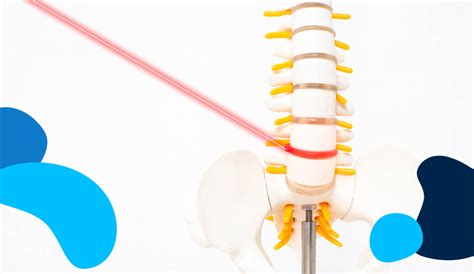 Spondilolistesi Cause Sintomi E Cure Doctolib