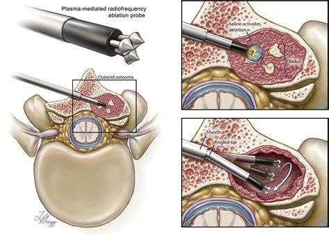 Percutaneous Plasma Mediated Radiofrequency Ablation Of Spinal Osteoid