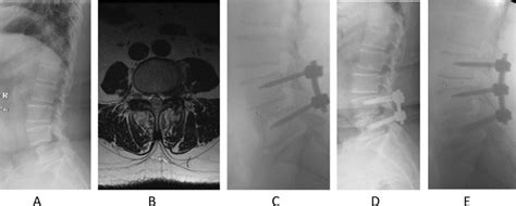 A 63 Year Old Female Underwent L4 5 Transforaminal Lumbar Interbody Download Scientific Diagram