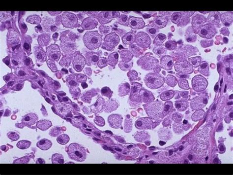 Glosario de Histopatología 3 Acúmulo intracelular