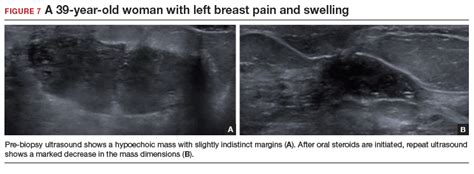 Evaluating Patients With Breast Concerns Lump Pain And Mastitis