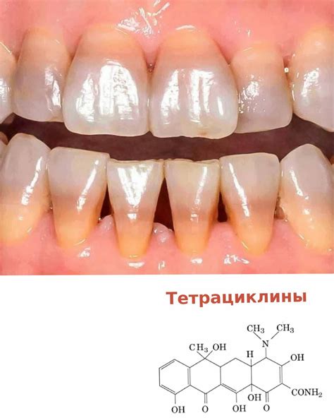 Некроз Зубов Фото Картинки фотографии