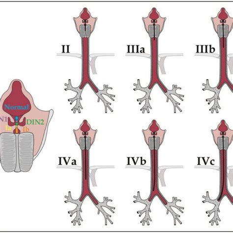 Transtracheal Approach To Type Iva Laryngotracheoesophageal Cleft Download Scientific Diagram