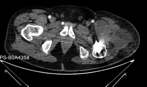 A Year Old Man With A Mass Following Hip Surgery Jbjs Image Quiz