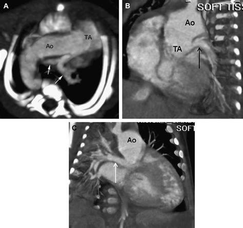 Truncus Arteriosus A Oblique Axial Maximum Intensity Projection