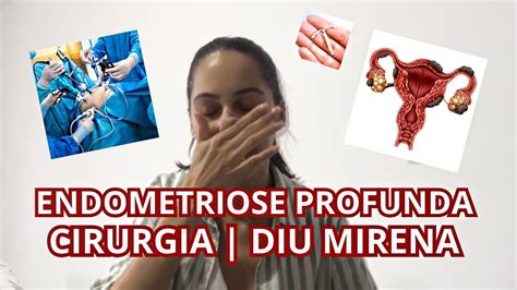 ENDOMETRIOSE PROFUNDA Cirurgia De Endometriose Diu Mirena