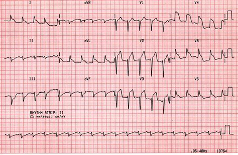 Case A8 Extensive Anterolateral Infarction Leading To Cardiac Arrest