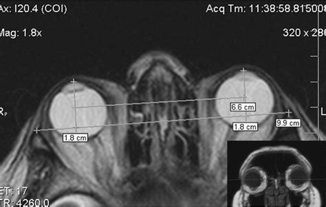 Evaluation Of Globe Position Within The Orbit Clinical And Imaging