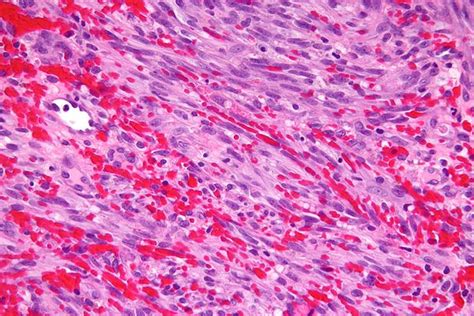 Kaposi Sarcoma Libre Pathology