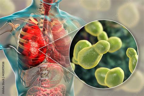 Pulmonary Cryptococcosis Invasion Of A Lung Tissue By Yeast Fungi Cryptococcus Neoformans With