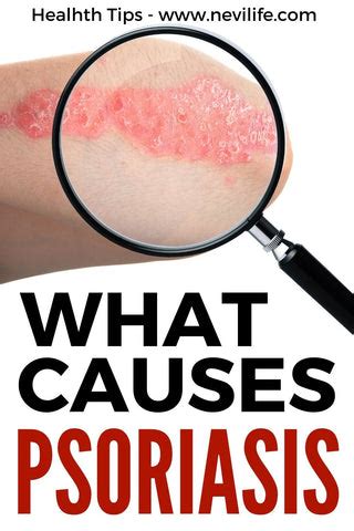 What Causes Psoriasis – nevilife