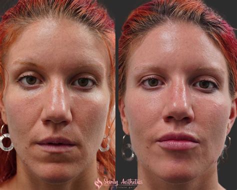 Smile Line Fillers Before After Results At Skinly