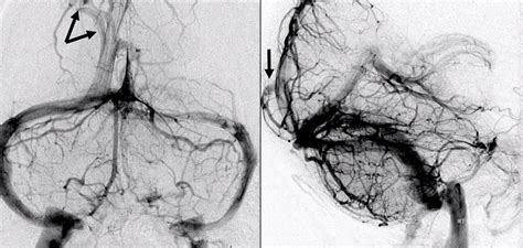 Dural Venous Channels | neuroangio.org