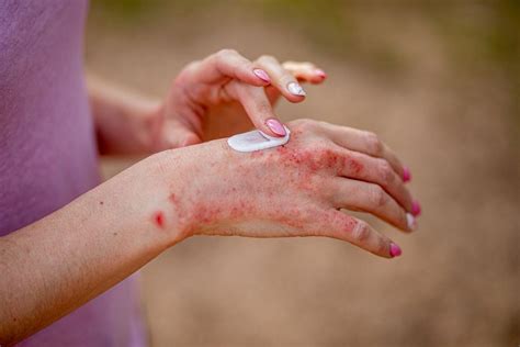 Expert Eczema Treatment In Mumbai Insights By Dr Deepam Shah Viva