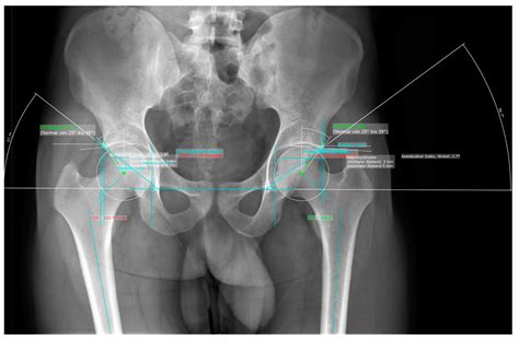 Osteoarthritis Hip X Ray Findings