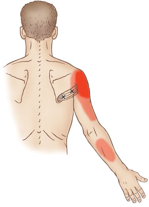 Teres Major Trigger Point Learn Muscles