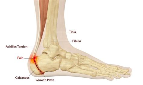 Achilles Tendonitis And Tendinopathy Treatment Glenside